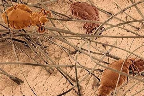 شپش موی کودکان